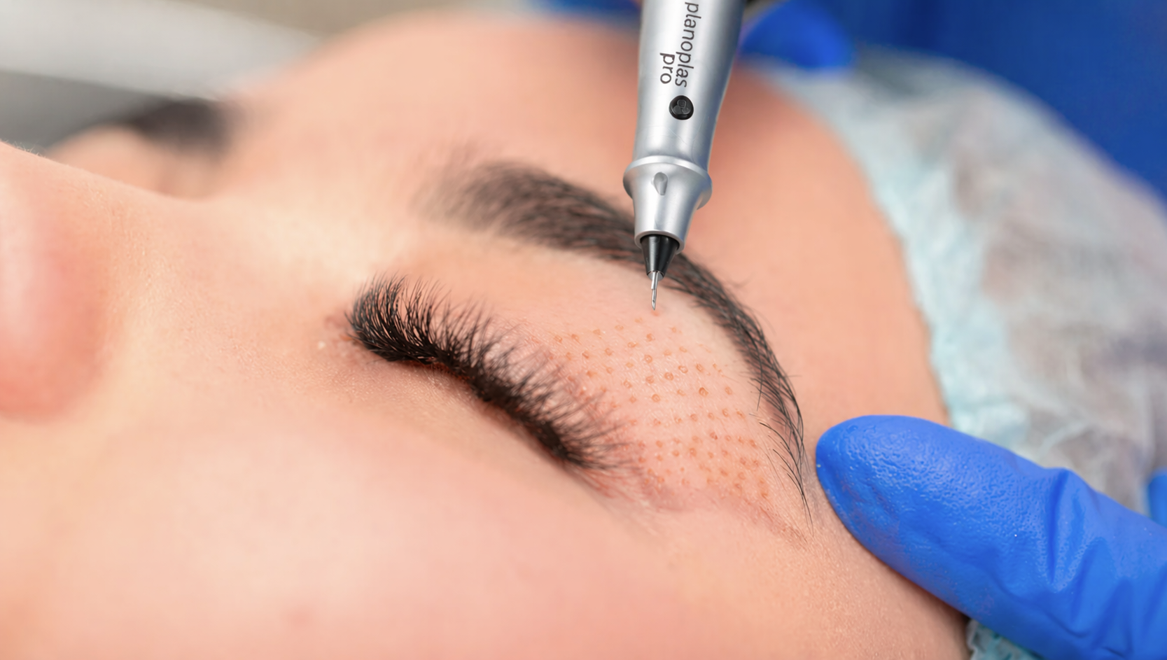 Planoplas Behandlung