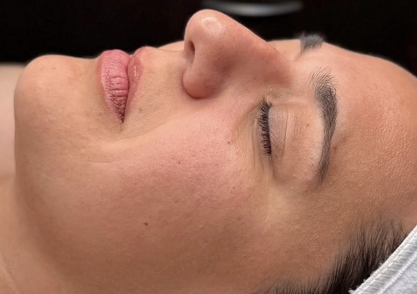 Gesichtsbehandlung GlowSolution – Vorher