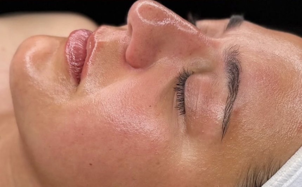 Gesichtsbehandlung GlowSolution – Nachher