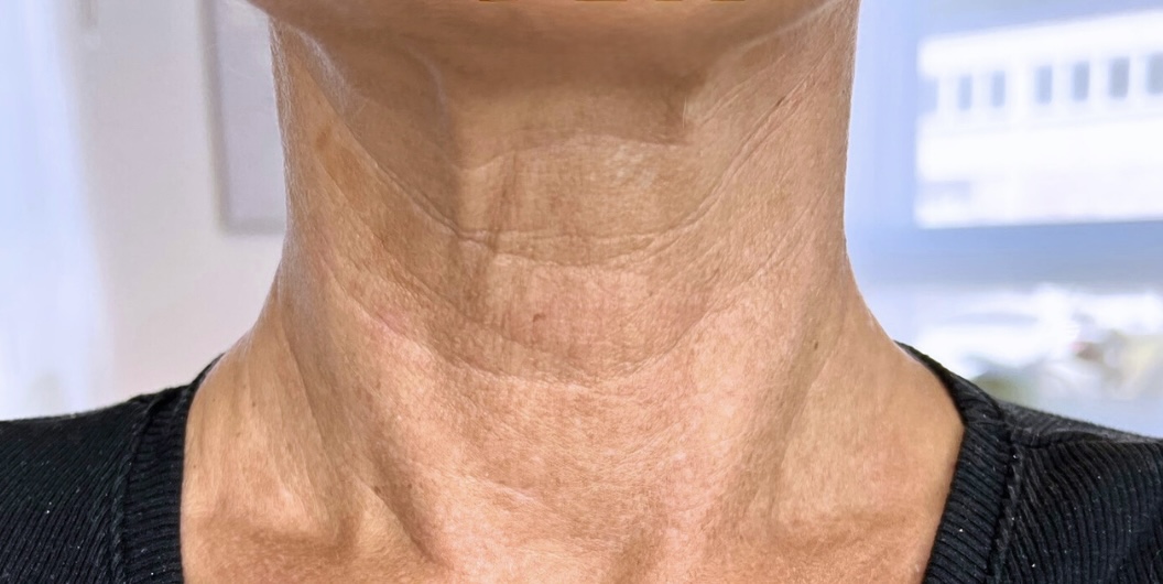 Hals & Dekolleté – Nachher