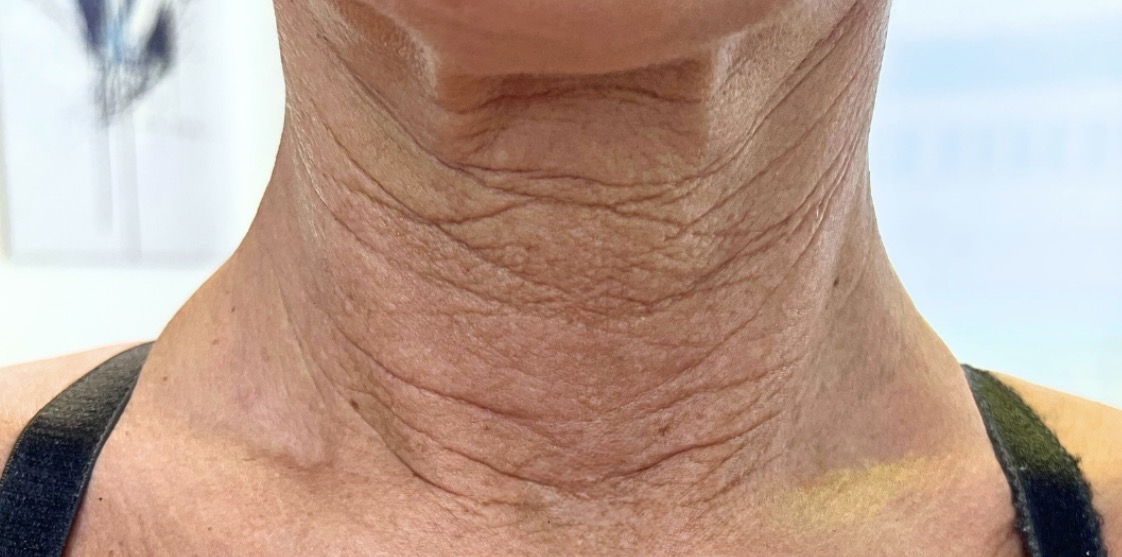 Hals & Dekolleté – Vorher