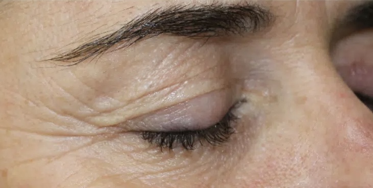 Oberlidstraffung (Planoplas) – Vorher