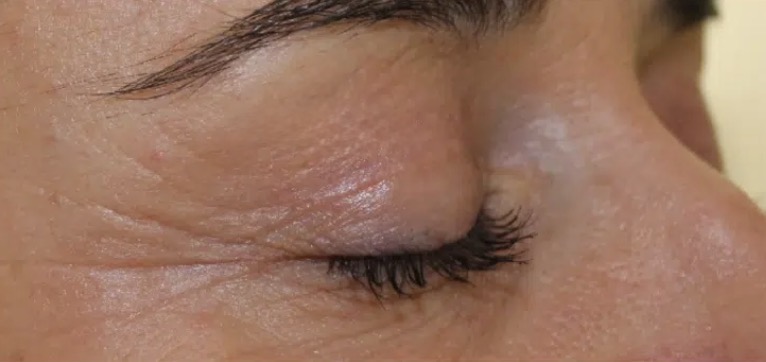 Oberlidstraffung (Planoplas) – Nachher